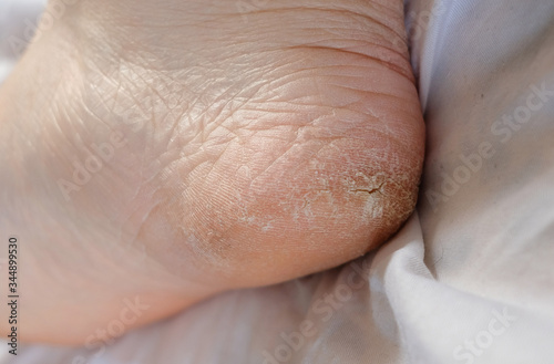 The Heel Of The Foot With Bad Skin Is Covered With Cracks. White Background. Pain. Monitor feet skin condition to prevent skin breakdown and trauma. © Оксана Смышляева