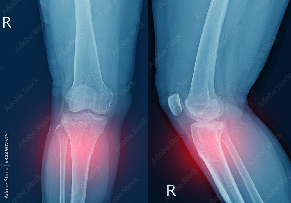 Xray knee Fracture proximal metaphysis of tibia.Depressed fracture of lateral tibial plateau