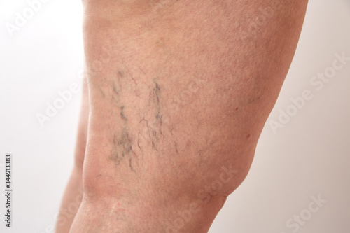 legs of a 40-year-old woman with stretch marks, cellulite and varicose veins close-up photo