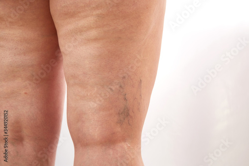 legs of a 40-year-old woman with stretch marks, cellulite and varicose veins close-up photo