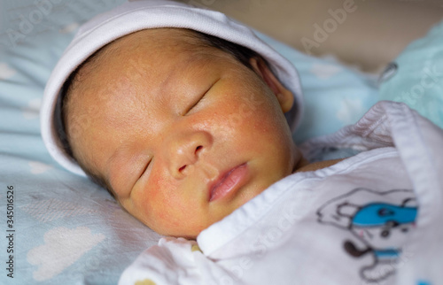 yellow skin colored neonatal jaundice happen in new born baby infant