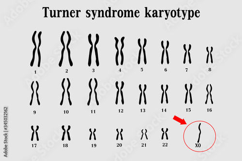 Karyotype of Turner syndrome (TS), also known 45,X, or 45,X0, is a genetic condition in which a female is partly or completely missing an X chromosome photo