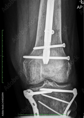 Radiographs, x-rays of a heavily injured motorcyclist with multiple fractures and implants.
