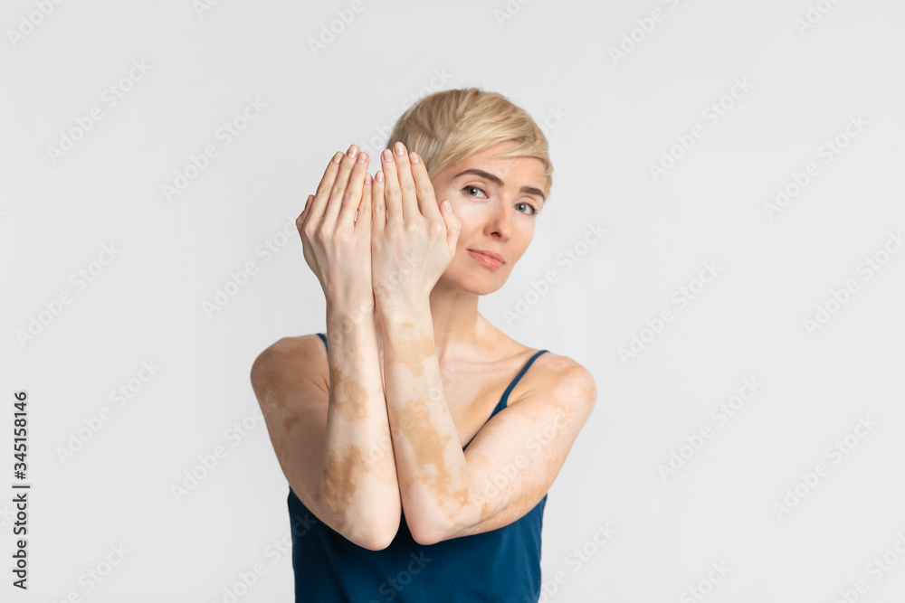 Overcome Fear Woman With Vitiligo Stops Hiding Stock Photo Adobe Stock Overcome Fear Woman With Vitiligo Stops Hiding Stock Photo Adobe Stock