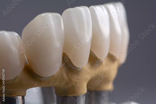Dental prosthetics on implants, artificial jaw with dentures on the table in the dental office