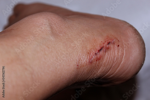 injury wound in male foot an accident