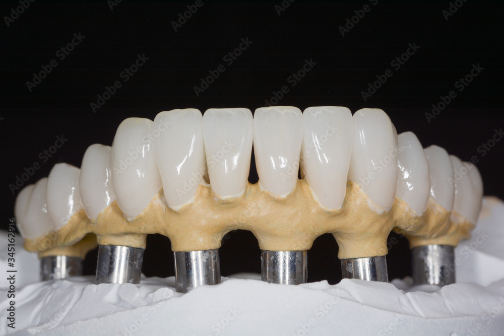 Dental prosthetics on implants, artificial jaw with dentures on the table in the dental office Dental prosthetics on implants, artificial jaw with dentures on the table in the dental office