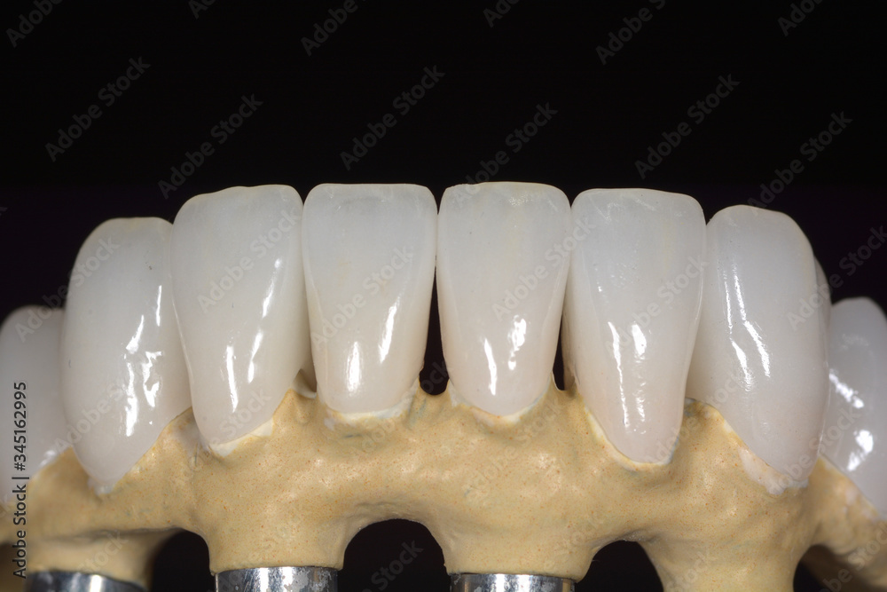 Dental prosthetics on implants, artificial jaw with dentures on the table in the dental office Dental prosthetics on implants, artificial jaw with dentures on the table in the dental office