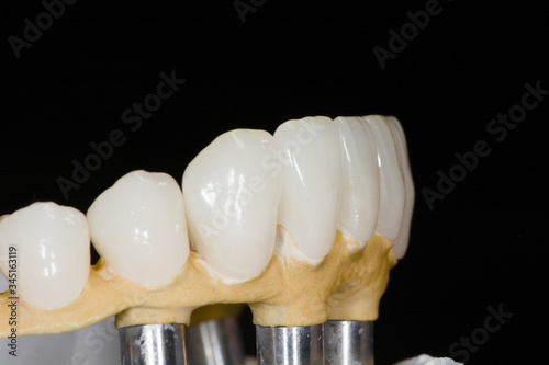 Dental prosthetics on implants, artificial jaw with dentures on the table in the dental office