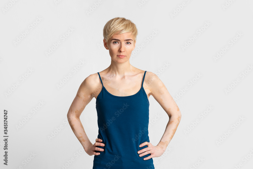 Serious woman with vitiligo on light background Serious woman with vitiligo on light background