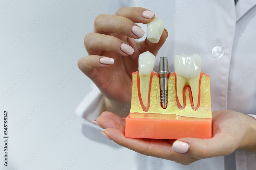 Stockfoto dental concept. the hands of a dentist doctor hold a model of ...