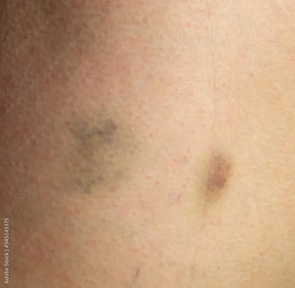 Bruise on human skin as a background.