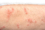 Skin disease rash on a man arm