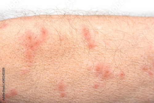 Photos Skin disease rash on a man arm