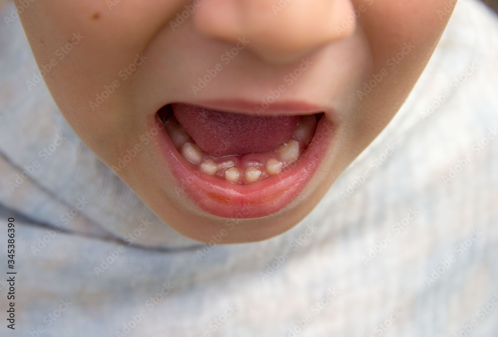 Foto de the child's root teeth, which grow next to the milk teeth