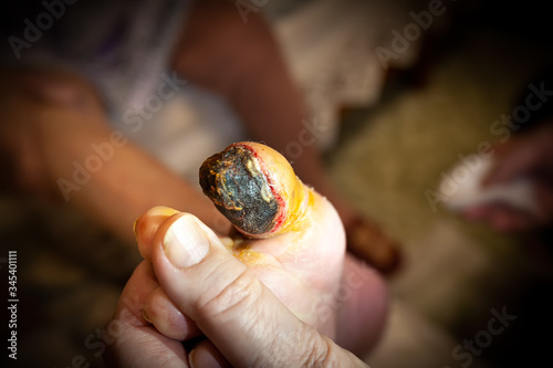 Fotografia Gangrene of the toe of an old grandmother