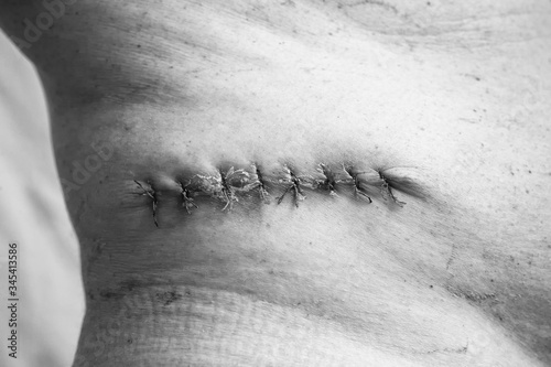 Department of Oncology Surgery. A picture of a postoperative medical suture after removal of a malignant tumor - moles. Malignant melanoma. Black and white photo, high contast. photo