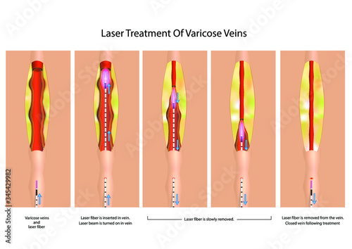 Laser treatment of varicose veins