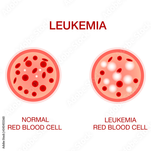 Infographic image of leukemia. Leukaemia disease awareness.Leukemia Blood Cells And Normal Blood Cells White Blood Cells Monocyte . Realistic vector picture .Medical and healthcare concept