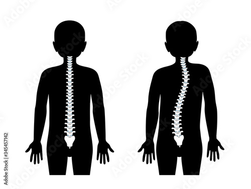 Scoliosis flat vector illustration