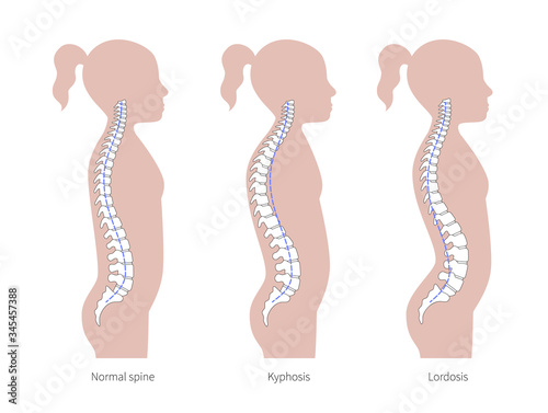 Kyphosis, lordosis flat vector illustration.