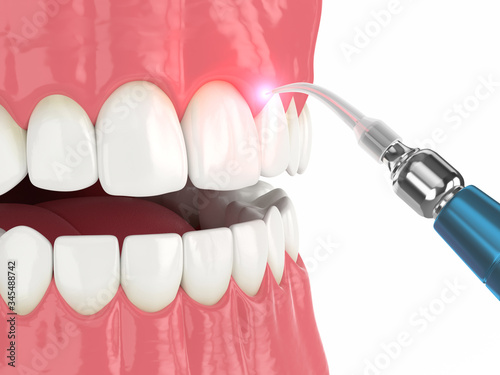 3d render of dental diode laser used to treat gums photo