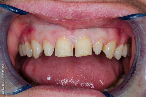 teeth, grinded for veneers