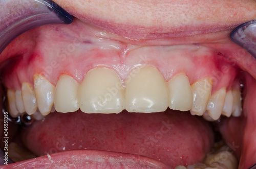 teeth of a young woman with veneer treatment
