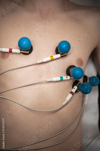 A patient with EKG electrodes attached to his body.