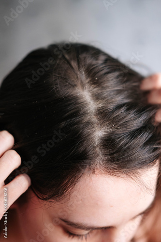 dandruff on the girls head, diseases of the scalp