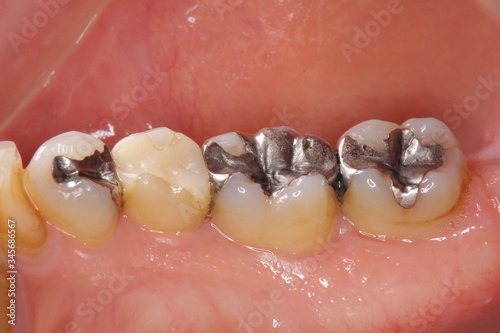 歯科　虫歯治療