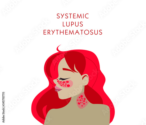 SLE, red systemic lupus erythematosus, red butterfly on the face skin rashes, acne. girl with a butterfly on her face. vector stock illustration white background, in cartoon style, place for text