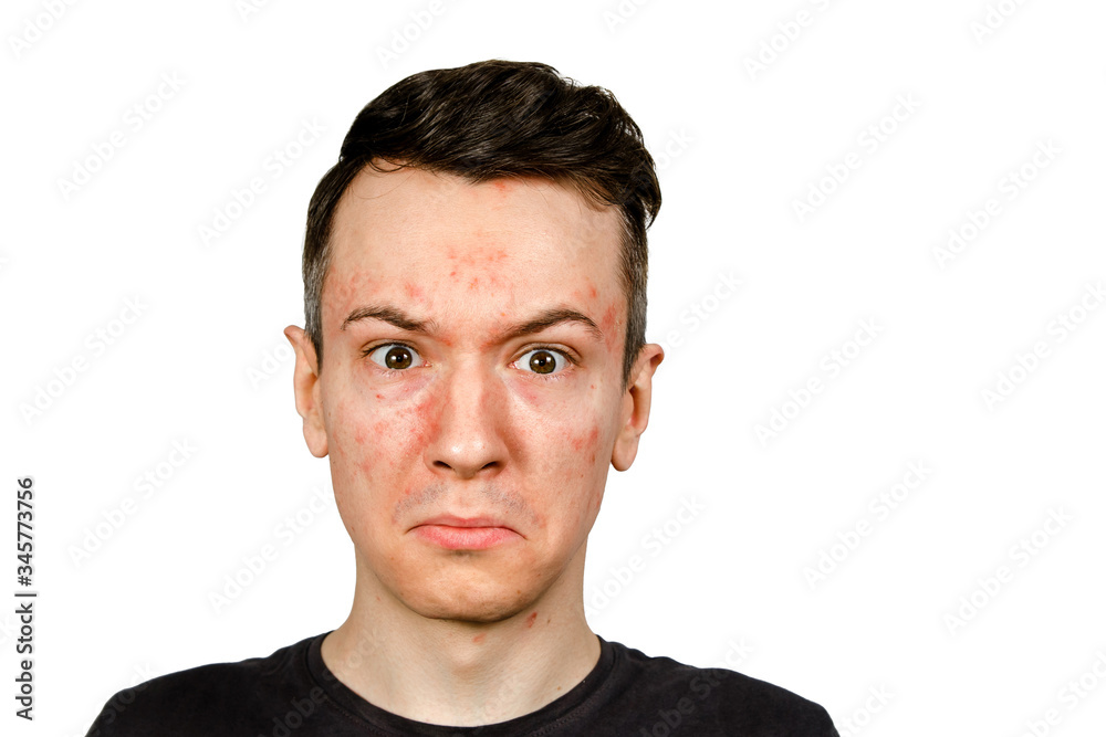 Portrait of young man with allergy, with red face, isolated Portrait of young man with allergy, with red face, isolated