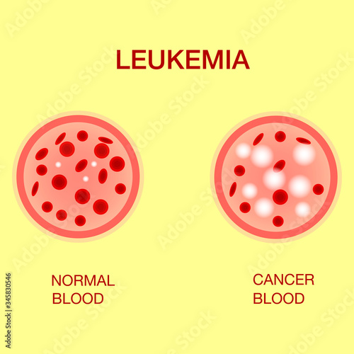 Infographic image of leukemia. Leukaemia disease awareness.Leukemia Blood Cells And Normal Blood Cells White Blood Cells Monocyte . Realistic vector picture .Medical and healthcare concept