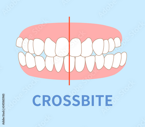 orthodontics  illustrations ; cross bite tooth photo