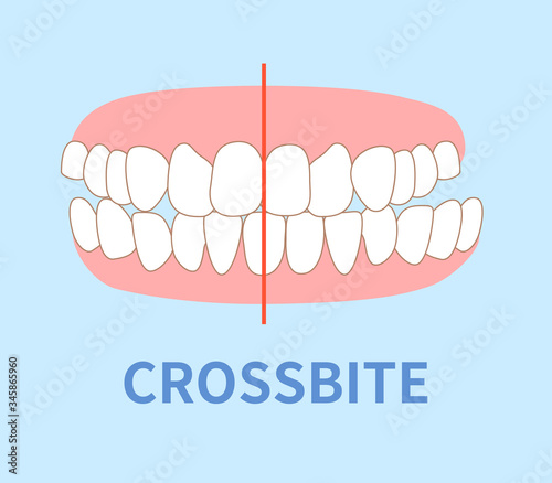 orthodontics  illustrations ; cross bite tooth