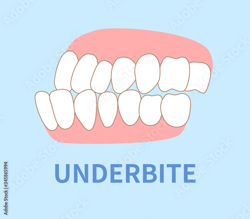 orthodontics  illustrations ; under bite tooth photo