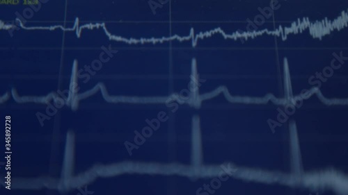 EKG machine showing the blood pressure waves