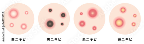 ニキビの症状　肌