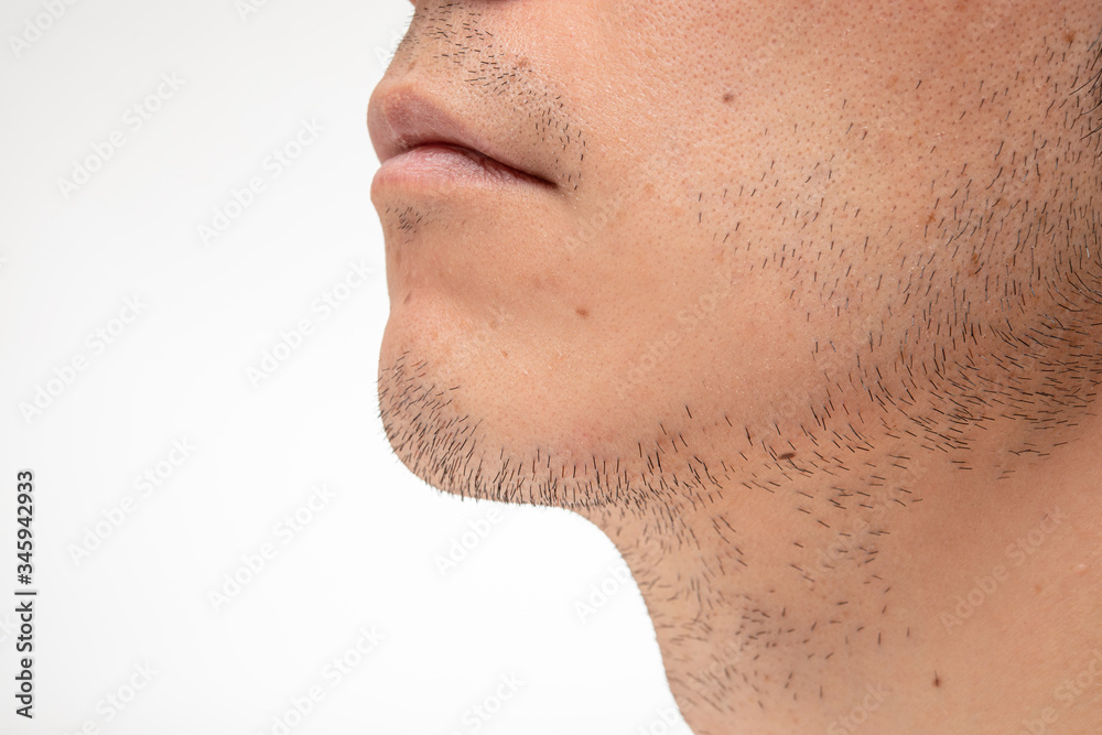 髭脱毛　beforeイメージ　3日間処理してない髭