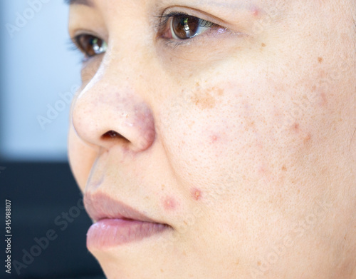 Problems facial skin is acne and blemishes.