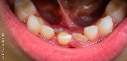 Second milk tooth moving just before falling out. It gets bloody.