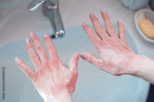 skin damage on hands from washing with soap photo