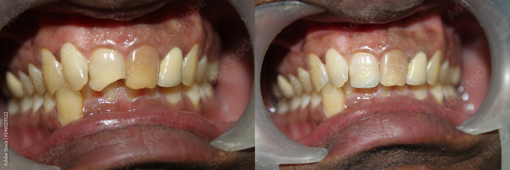 Obraz premium Fractured tooth restored with composites