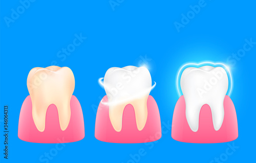 Set of  clean and dirty tooth. Step of yellow to white. Dental care concept, illustration isolated on blue background.