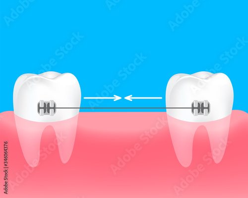 Spacing teeth. Braces to keep the teeth together. Dental care concept. Gums and teeth illustration.