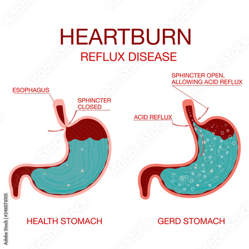 Heartburn and Gastroesophageal Reflux Disease GERD.Gastritis and acid reflux, indigestion and stomach pain problems. Stomach acid moving up into the esophagus causing acid reflux symptoms. Heartburn