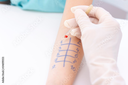 Allergen test on hand. child undergoing procedure of allergen skin test in clinic.