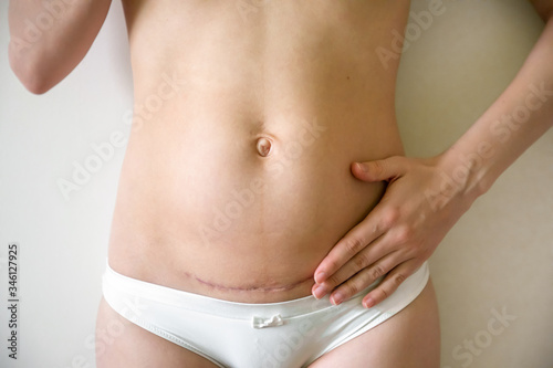 Closeup of woman belly with scar from a cesarean section