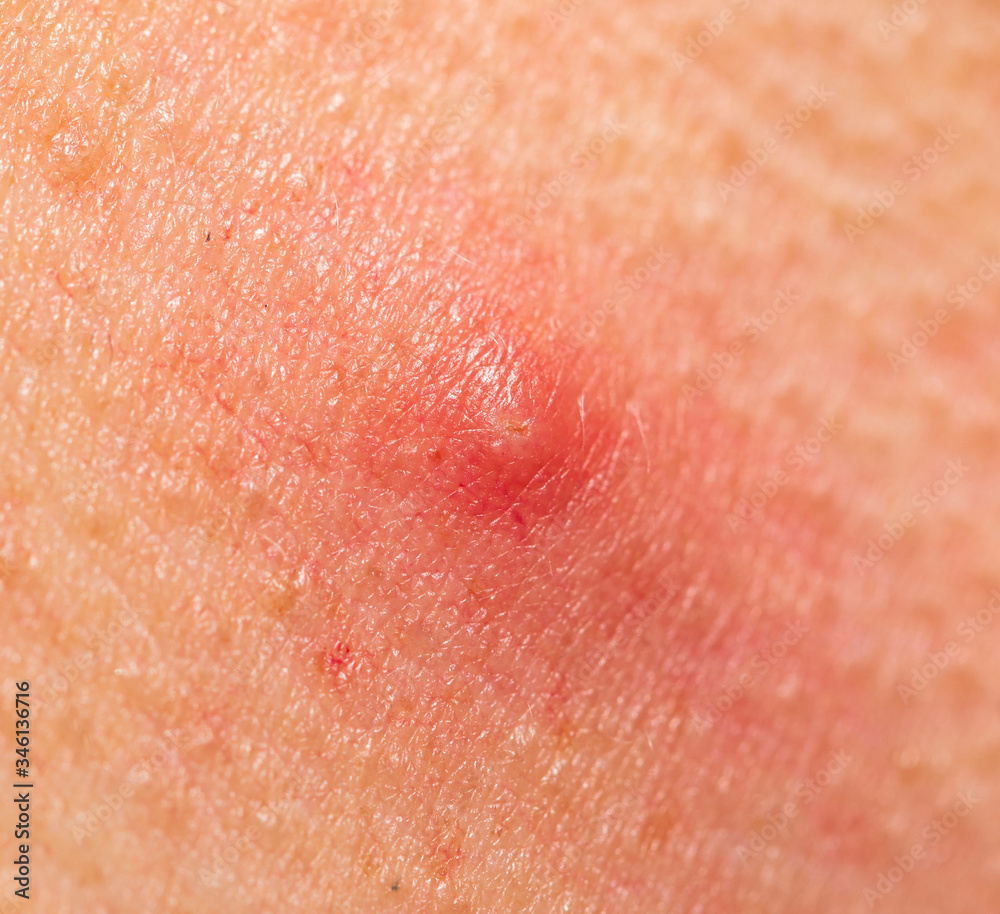 red acne on the face red acne on the face